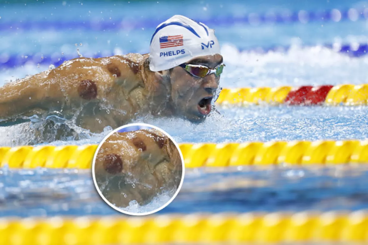 Las manchas se deben a una terapia llamada cupping.
