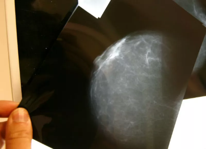 radiograf�as de mama