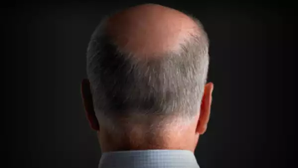 Buenos productos, alimentación sana y menos estrés ayudan a tratarla o prevenirla. (Foto:Getty Images)