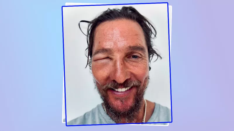 Matthew McConaughey muestra su ojo hinchado tras ser picado por una abeja