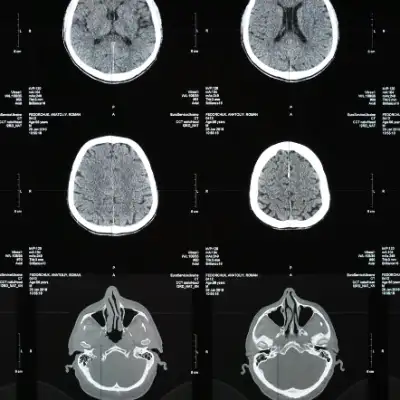 CTE enfermedad cerebro NFL .png