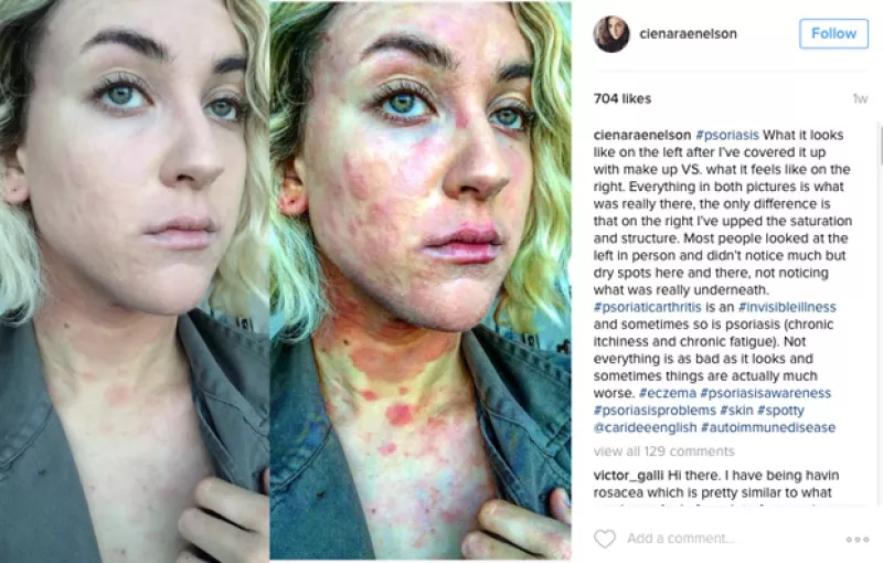 Ciena Rae Nelson decidió mostrar su psoriasis usando un filtro que dejó al descubierto la gravedad de su padecimiento. ¿Su finalidad? Crear conciencia al respecto.