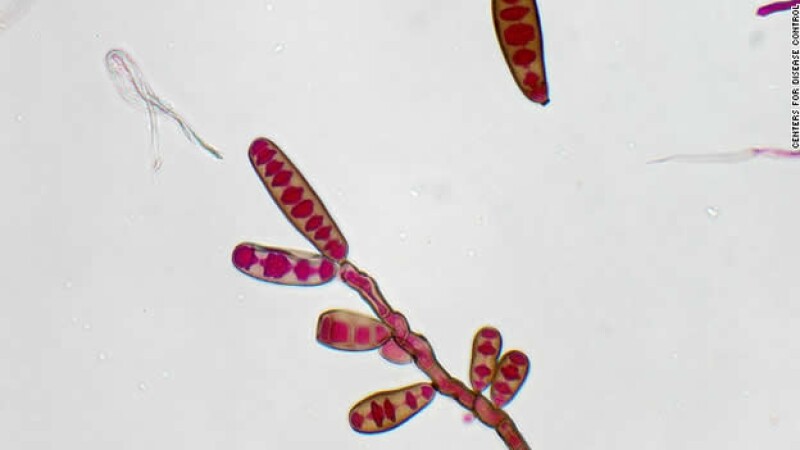 hongo meningitis