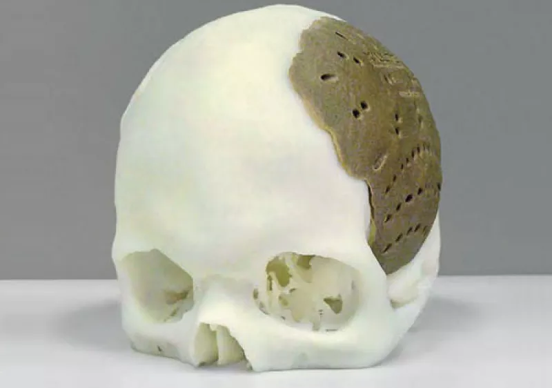 cr�neo impreso en 3D