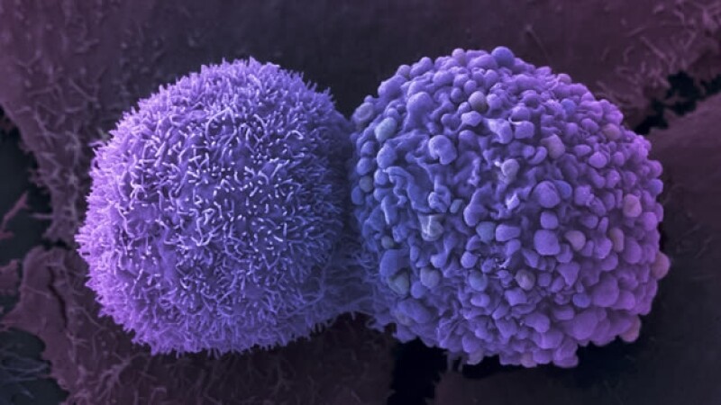 celulas de cancer de pulmon
