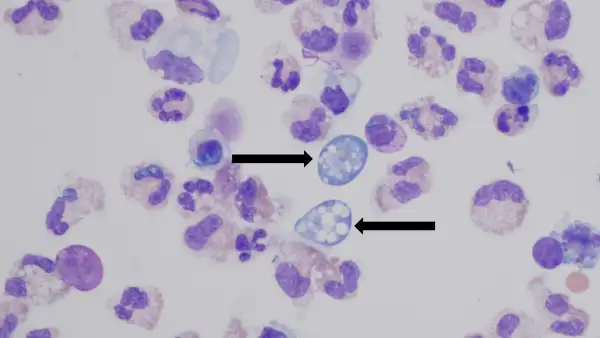 Ameba comecerebros en color azul que infectan a las células del cerebro en color morado.jpg