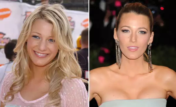 Tal vez la de Blake es la cirugía plástica favorita para bien. Su cambio fue radical.