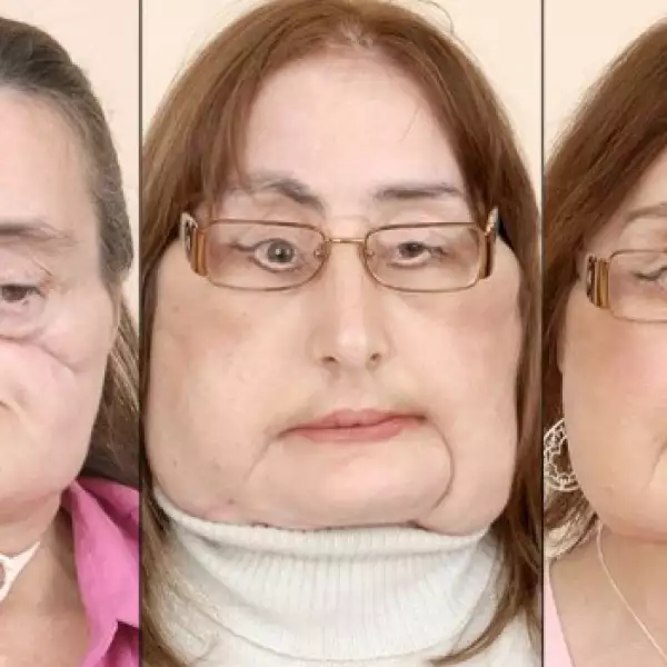 Connie Culp trasplante cara 2004