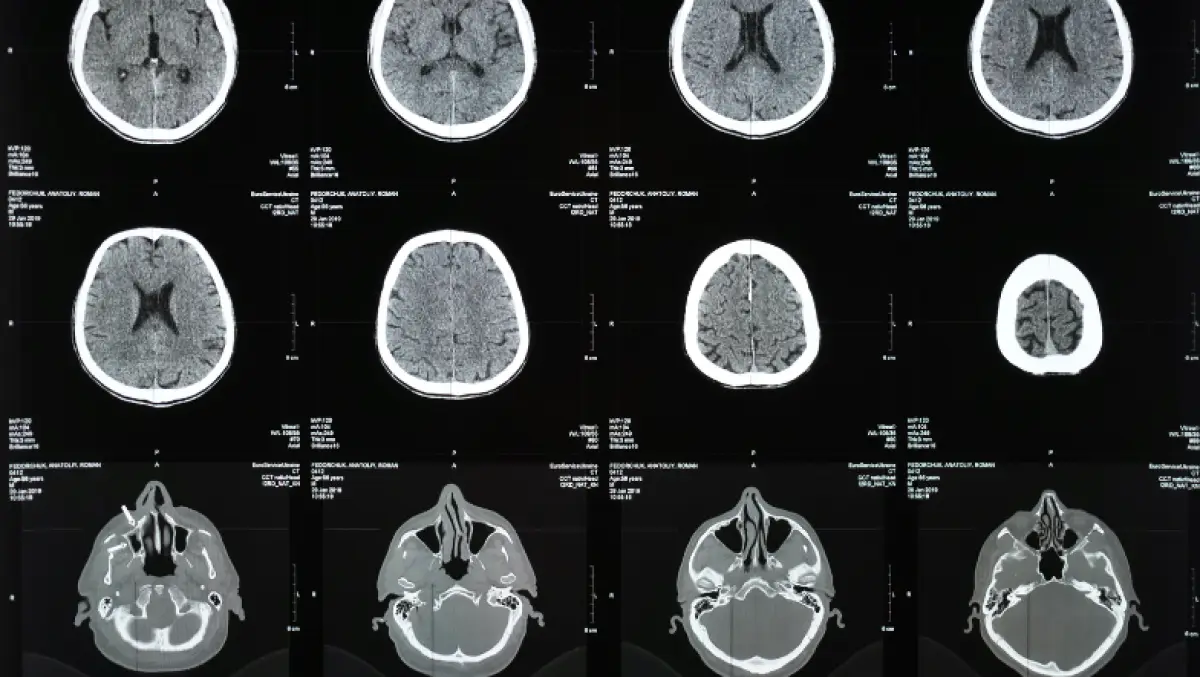 CTE enfermedad cerebro NFL .png
