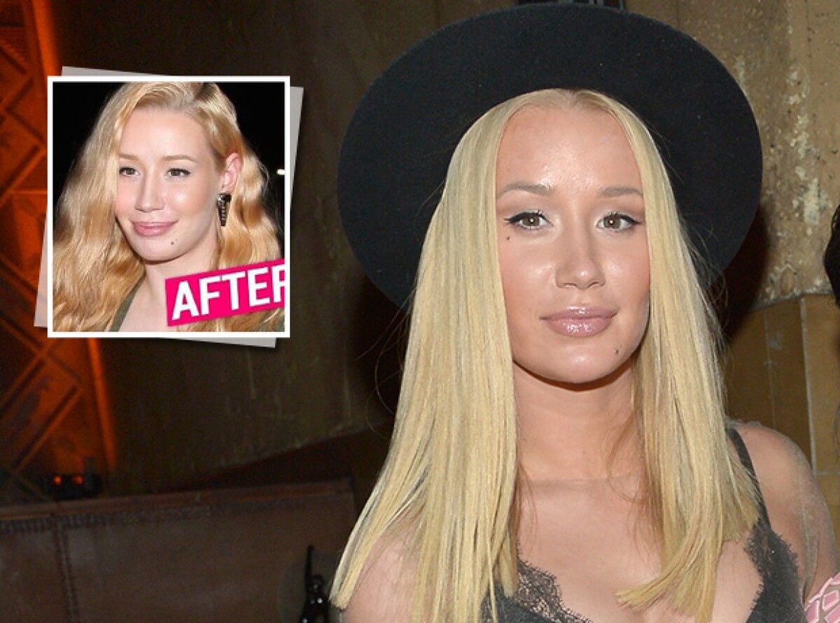 Iggy Azalea ¿sigue transformando su cara? Iggy Azalea ¿sigue transformando su cara?