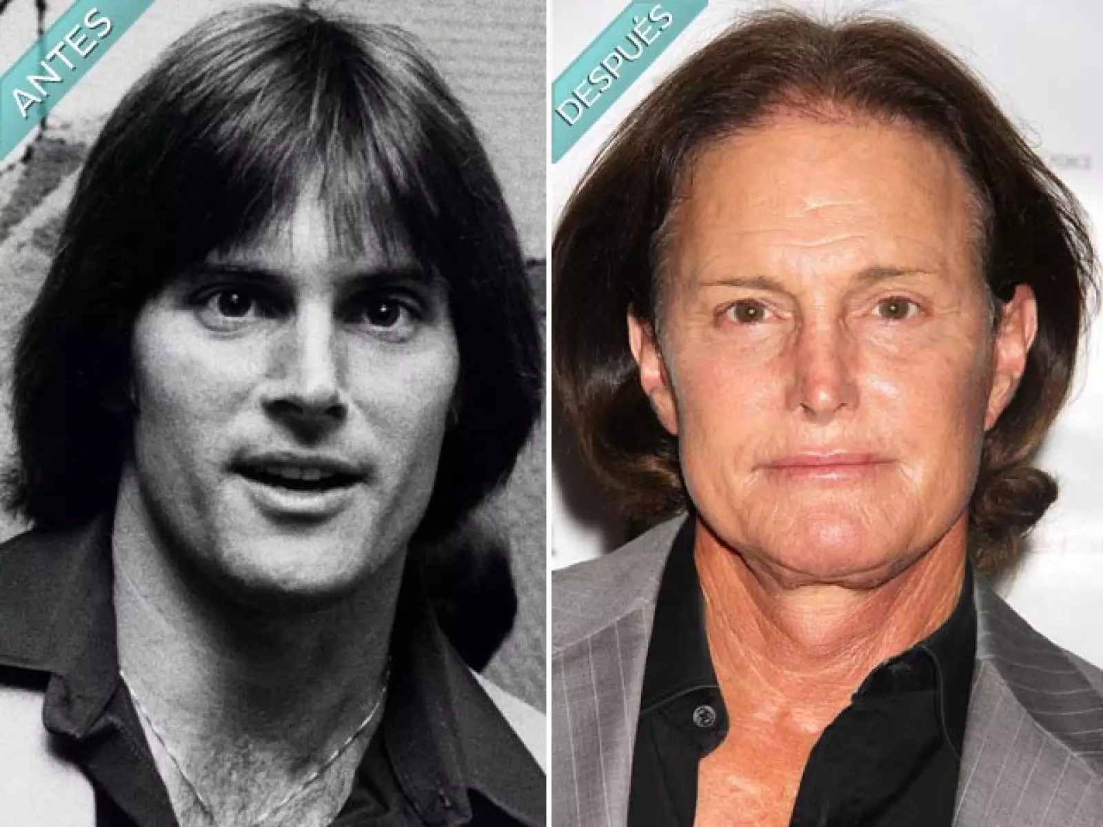 Bruce Jenner fue campeón de Juegos Olímpicos y el galán de moda, pero la década de los 80 lo impulsó a realizarse rinopastias, liftings facial e implante de barbilla. Ahora quiere retirarse la manzana de Adán.