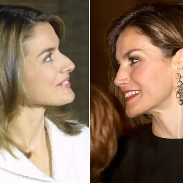 Con el paso de los años la reina Letizia ha ido estilizando su rostro, uno de sus cambios más notorios es su nariz. Se dice que se hizo una septorrinoplastia para corregir las irregularidades del tabique nasal.