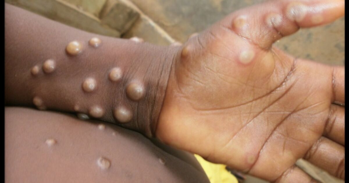 The advance of monkeypox: What to do when it arrives in Mexico? The advance of monkeypox: What to do when it arrives in Mexico?