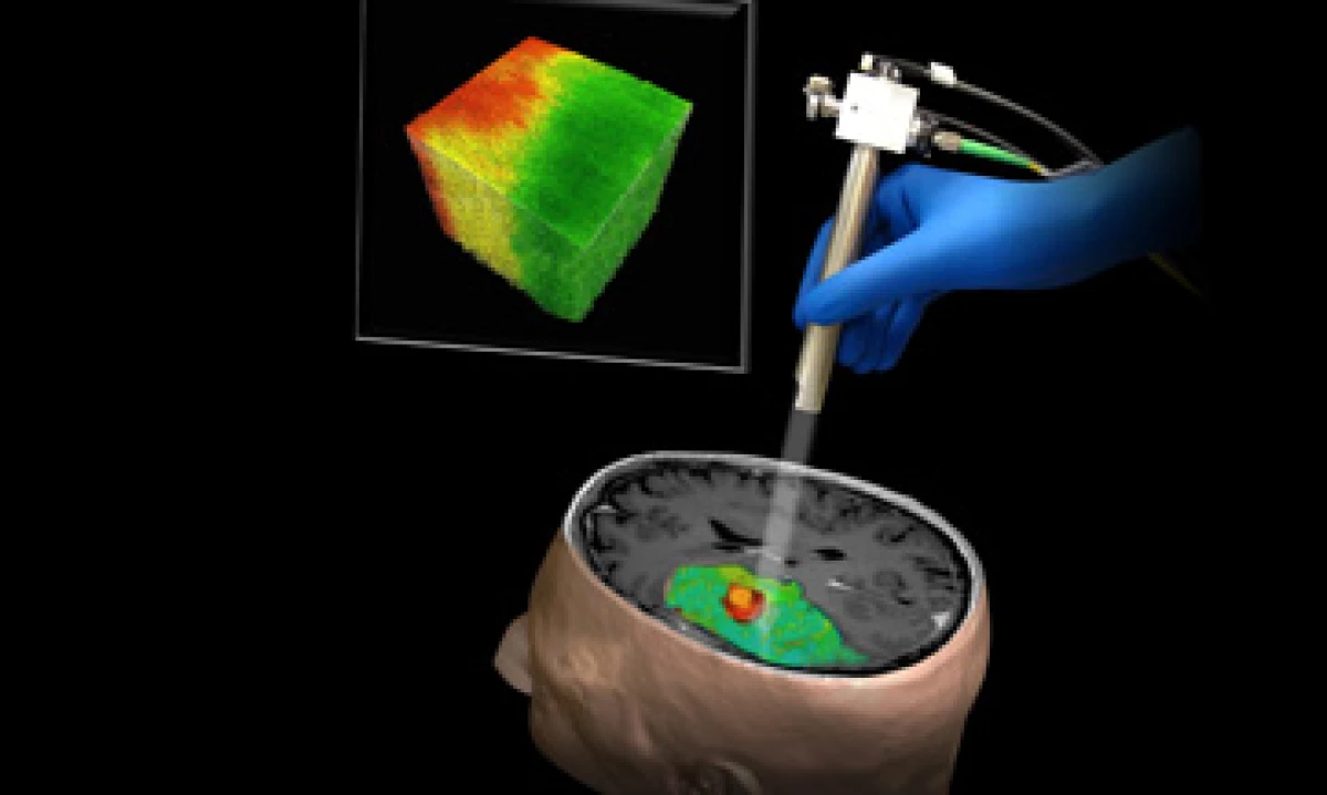 La tomografía de coherencia óptica ayuda a los cirujanos a diferenciar el tejido canceroso del sano.(Foto: Carmen Kut, Jordina Rincon-Torroella, Xingde Li and Alfredo Quinones-Hinojosa/Johns Hopkins Medicine )
