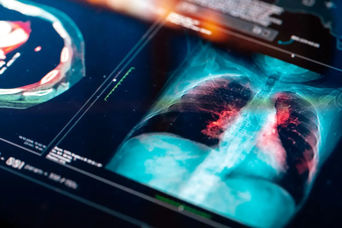 Prueban la primera vacuna contra el cáncer de pulmón