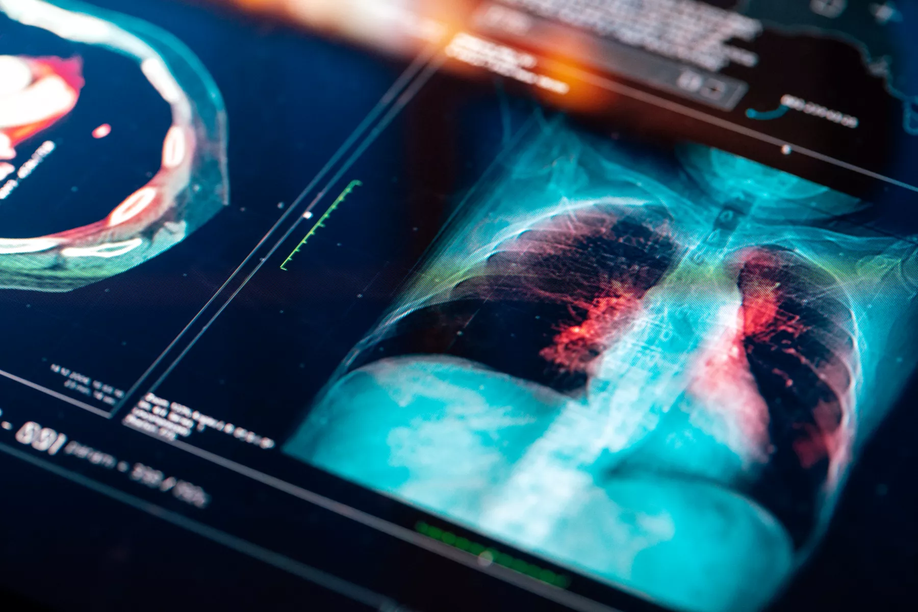 pulmones-neumococo