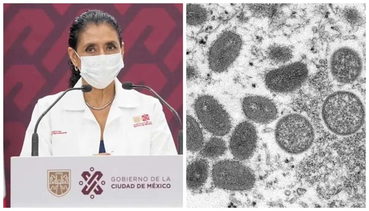 viruela del mono cdmx