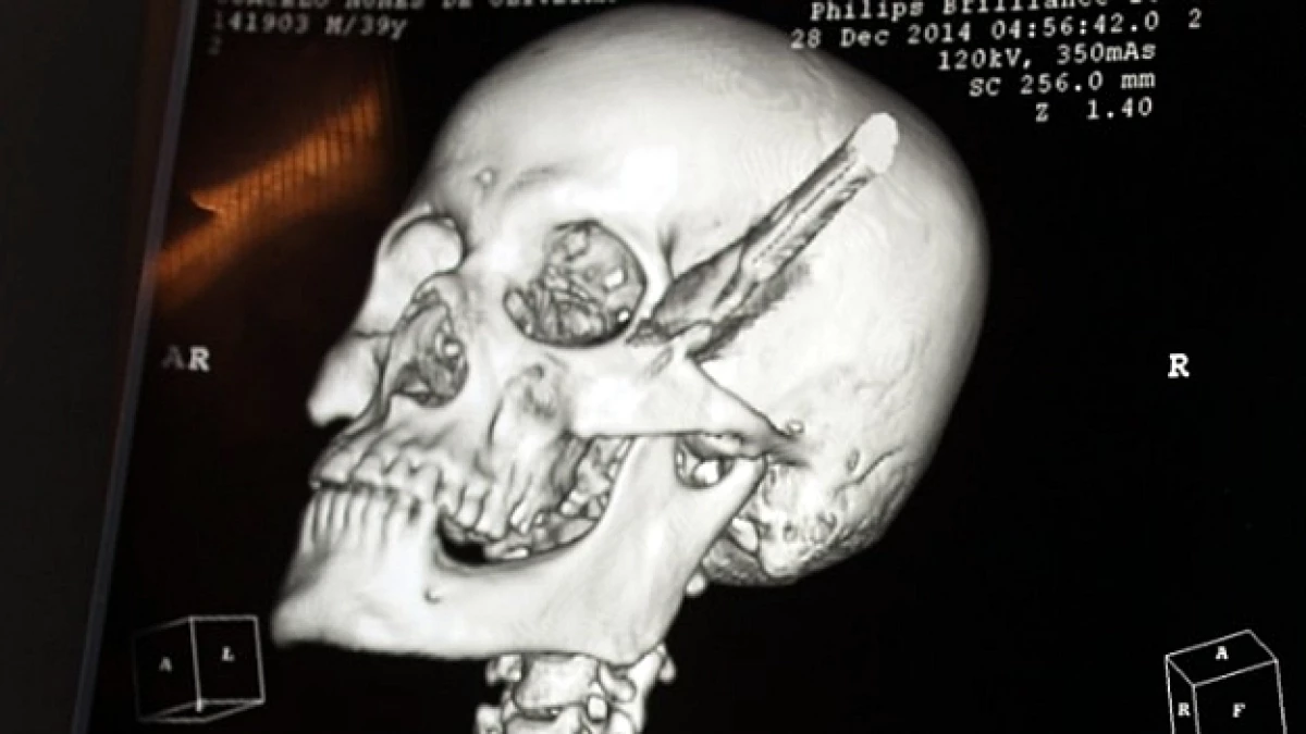 Radiografia brasileño cuchillo cabeza