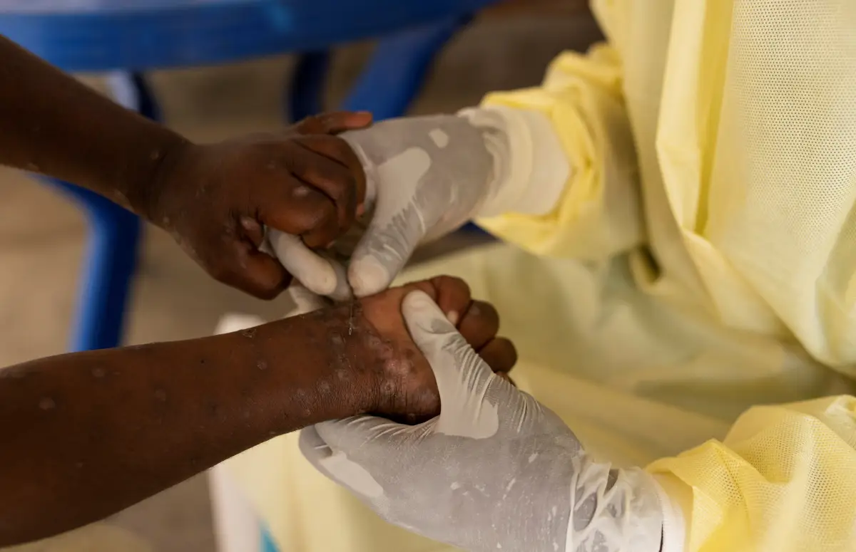 Christian Musema, una enfermera de laboratorio, toma una muestra de un niño declarado un caso sospechoso de Mpox, una enfermedad infecciosa causada por el virus de la viruela del mono que provoca una erupción dolorosa, ganglios linfáticos agrandados y fiebre; en el centro de tratamiento en Munigi, después de los casos de Mpox en el territorio de Nyiragongo, cerca de Goma, provincia de Kivu del Norte, República Democrática del Congo, 19 de julio de 2024.