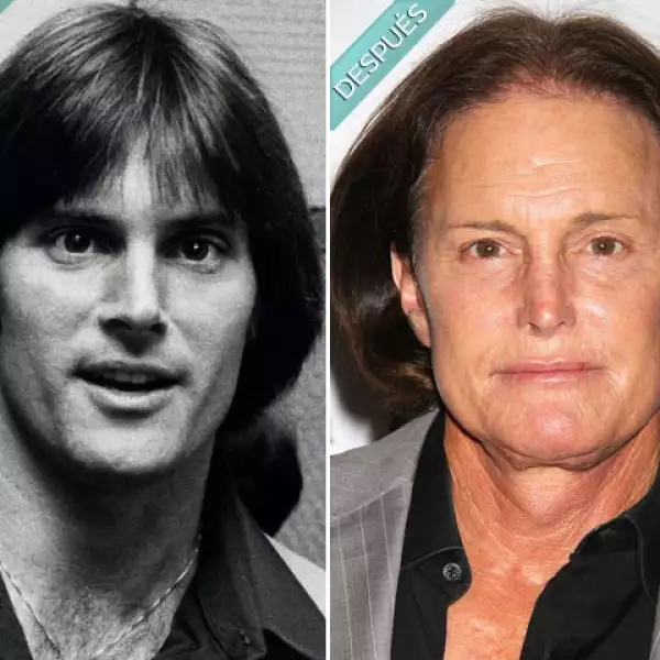 Bruce Jenner fue campeón de Juegos Olímpicos y el galán de moda, pero la década de los 80 lo impulsó a realizarse rinopastias, liftings facial e implante de barbilla. Ahora quiere retirarse la manzana de Adán.
