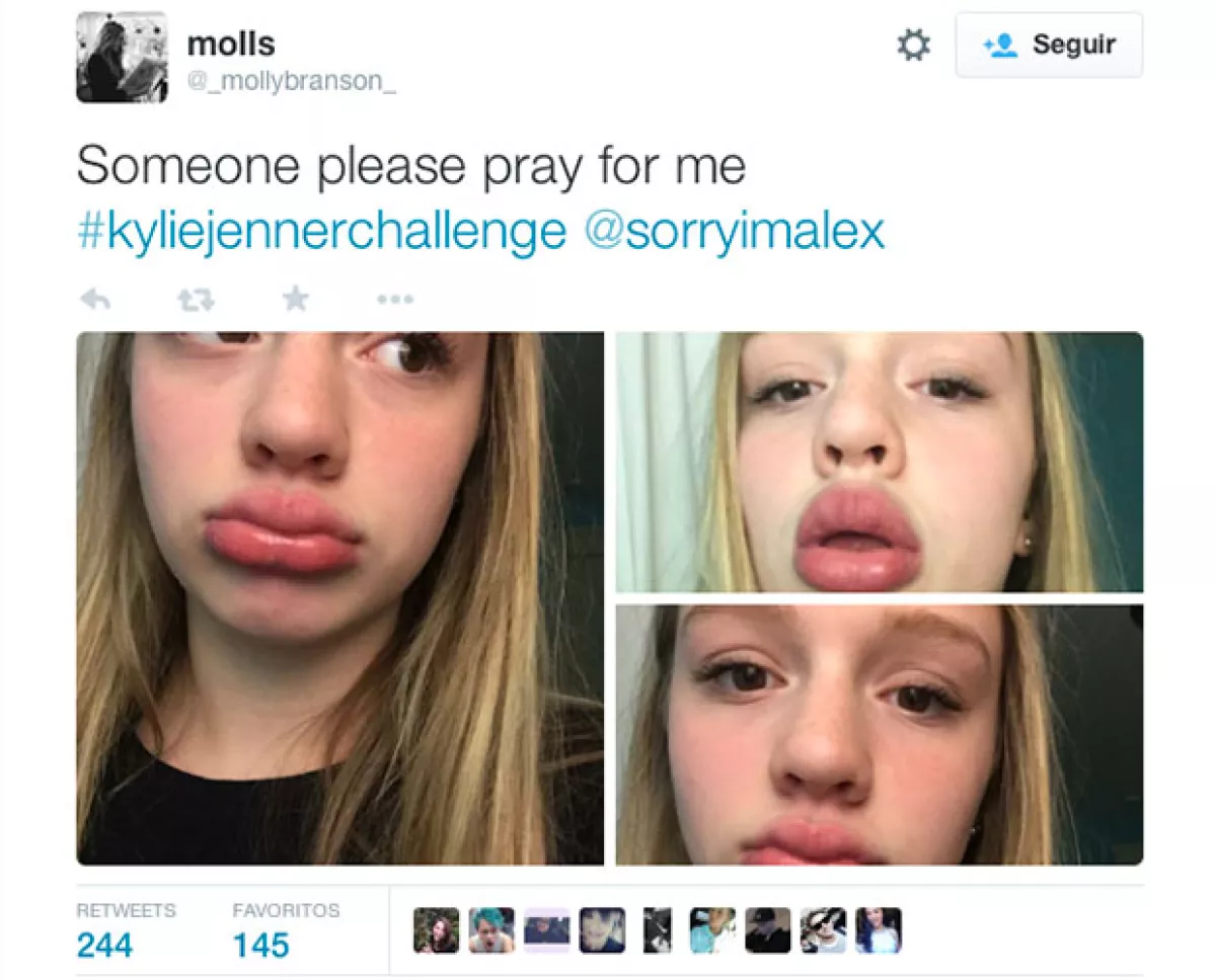 Moretones y labios inflamados, es lo que causa este reto.