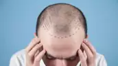 trasplante de cabello .png