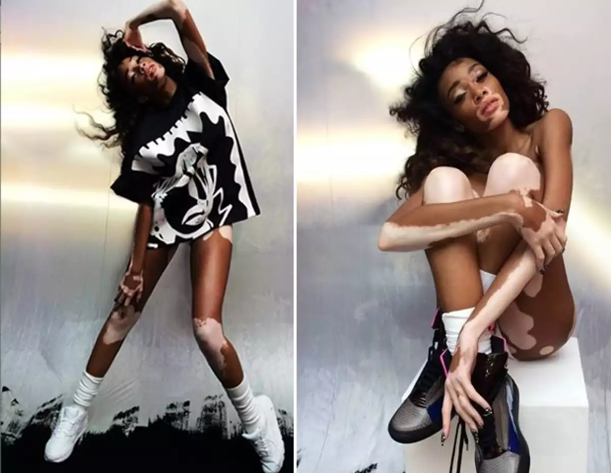 La modelo afroamericana de 19 años de edad ha ganado popularidad debido a su enfermedad, la cual la impulsado a destacar en el mundo de la moda.