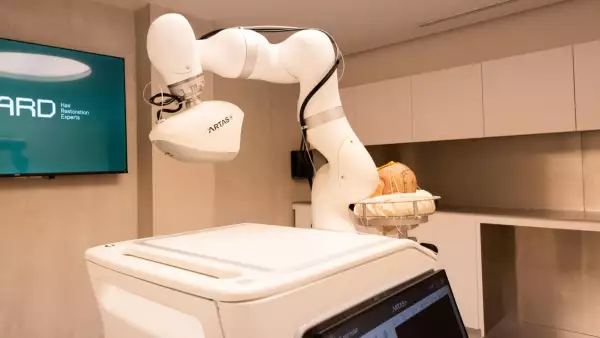 ARTAS iX, el robot que ayuda en injertos capilares
