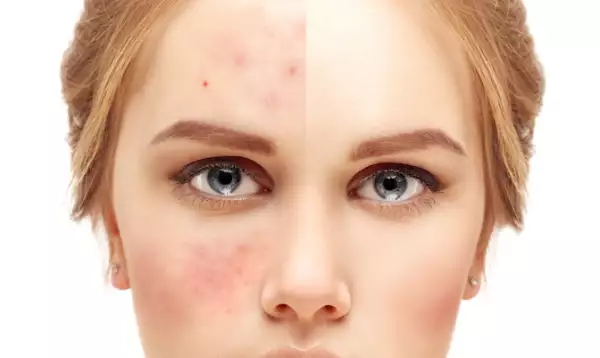 Girl  with problem and clear skin.