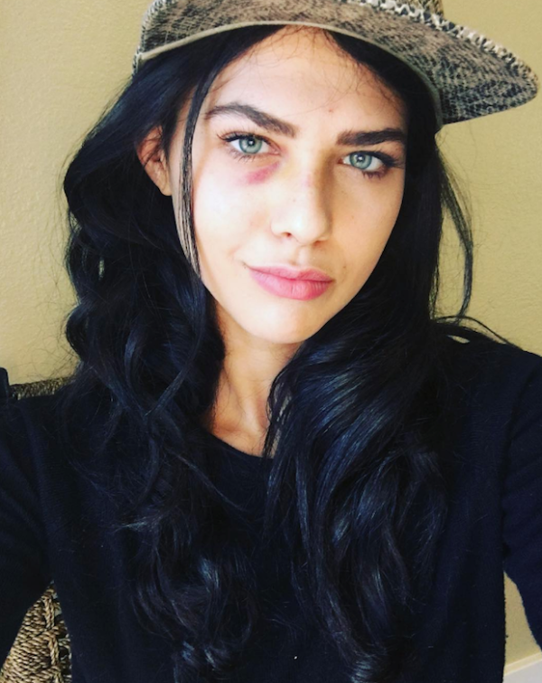 Un drone golpeó a la modelo Jess Adams en el ojo izquierdo.