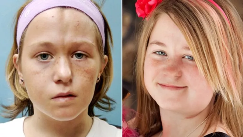 cirugia operacion facial