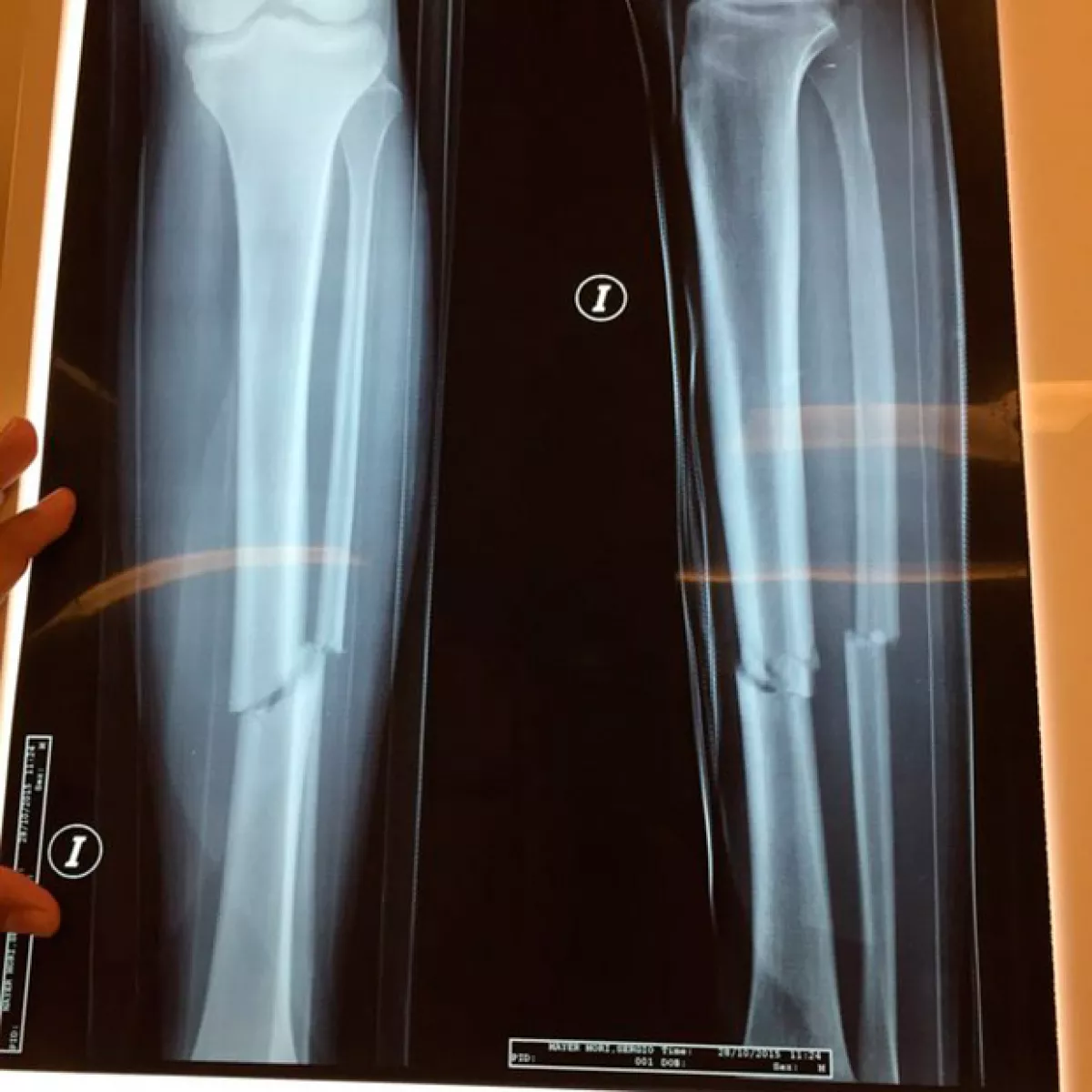 Esta es la radiografía de la fractura que tuvo Sergio Mayer Mori.