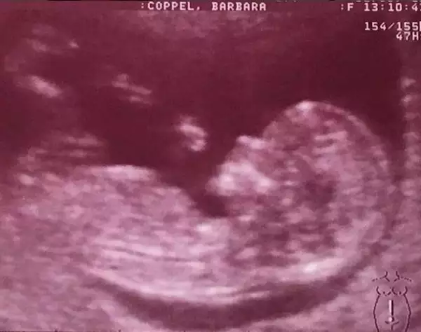 Esta es la primera foto del ultrasonido que compartió Bárbara en sus redes sociales.