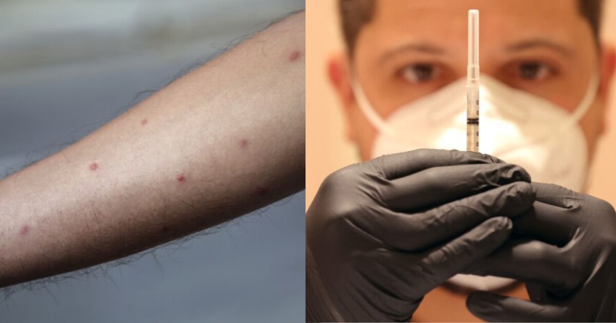 Is there a vaccine against monkeypox? Is there a vaccine against monkeypox?