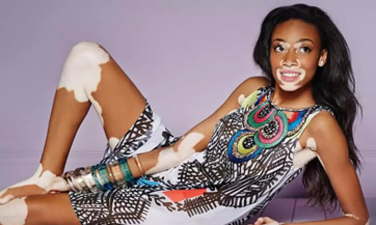 Diesel y otras marcas hacen de la imperfección, la nueva belleza. (Foto: Cortesía de Facebook/Winnie Harlow )