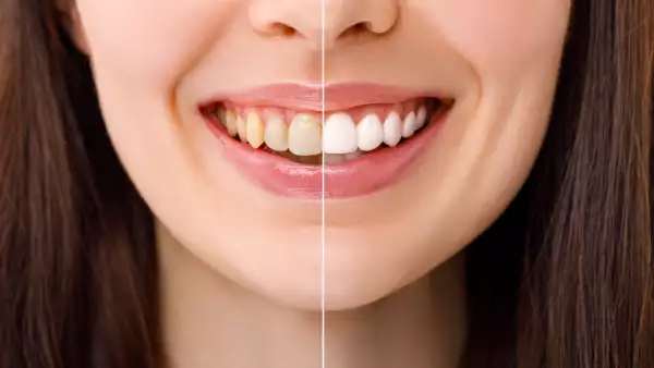 El precio de una sonrisa perfecta: Lo que no te dicen del blanqueamiento dental