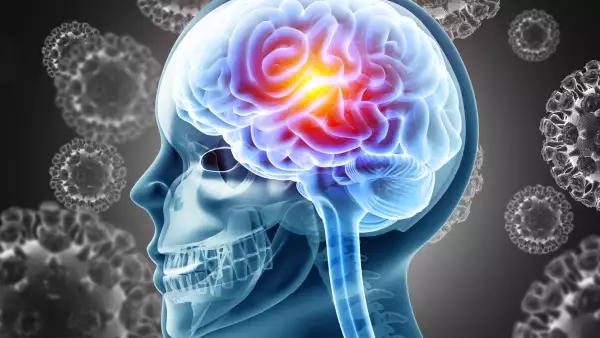 Meningitis, inflamación grave de las membranas protectoras que rodean el cerebro y la médula espinal. Infección por virus o bacterias. Ilustración en 3D