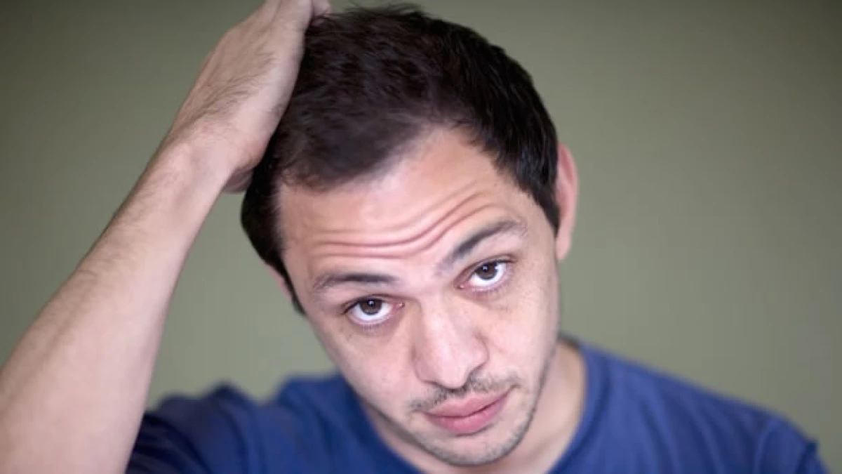 calvicie_hombre_cabello_alopecia